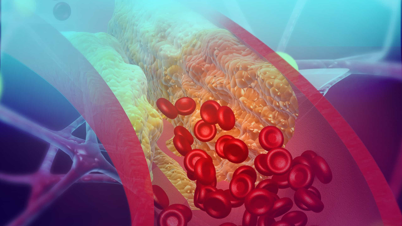 Colesterol: como prevenir e os erros que podem entupir suas artérias