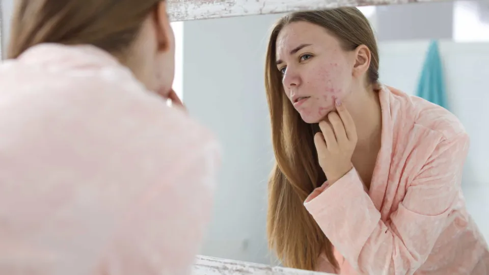 Cicatrizes de acne, como amenizar e tratar?